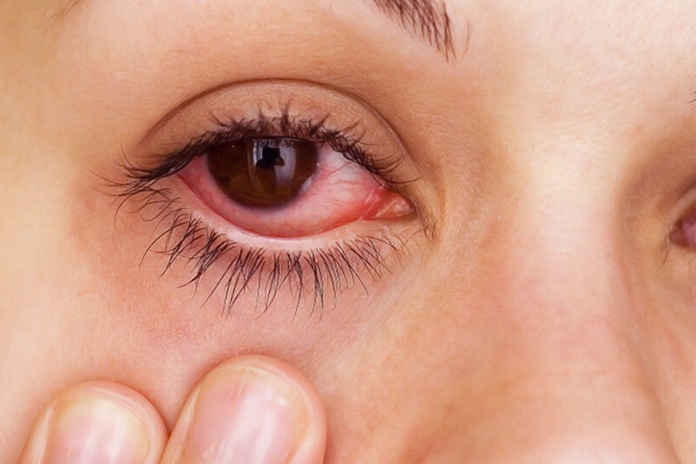 Akys paraudo ir peršti? Tai gali signalizuoti apie prasidėjusią sausų akių ligą